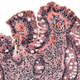 Biopsia de un intestino delgado en el que se aprecian lesiones causadas por la celiaquía.